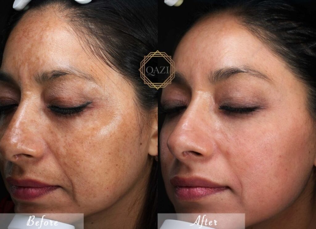 Hydroquinone 4% for Melasma and Hyperpigmentation: Evidence-Based Results 3 image 1
