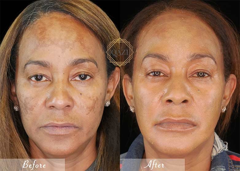 Hydroquinone 4% for Melasma and Hyperpigmentation: Evidence-Based Results 2 image 2