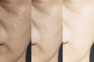 Hydroquinone 4% for Melasma and Hyperpigmentation: Evidence-Based Results